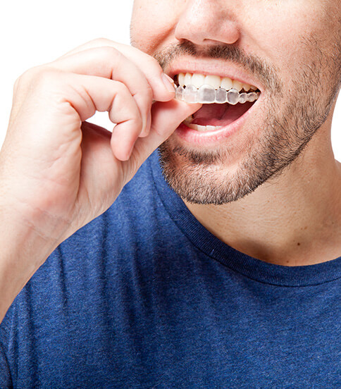 closeup of a person inserting a clear aligner onto their teeth