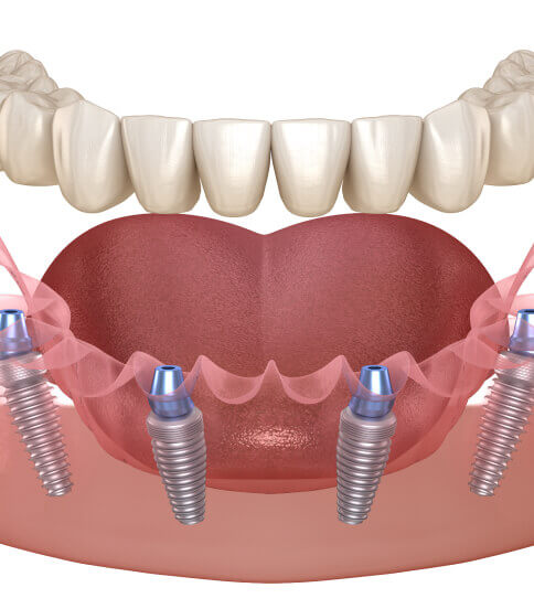 illustration of dental implants