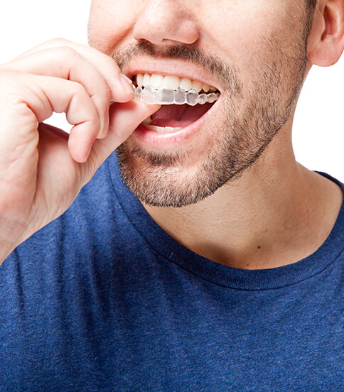 man putting on a clear aligner